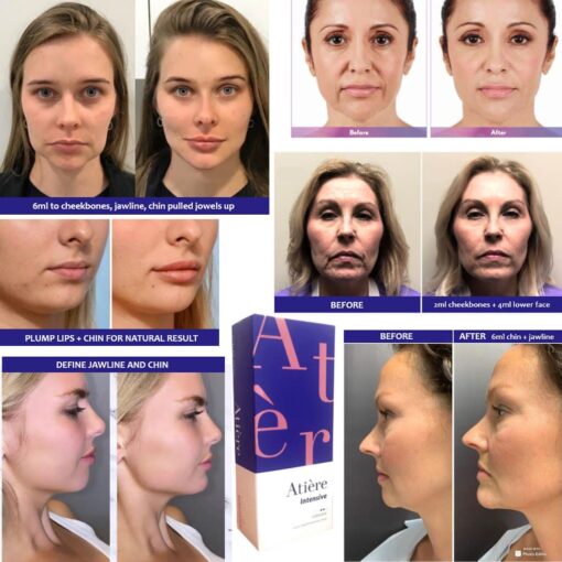 Filler Atiere 4